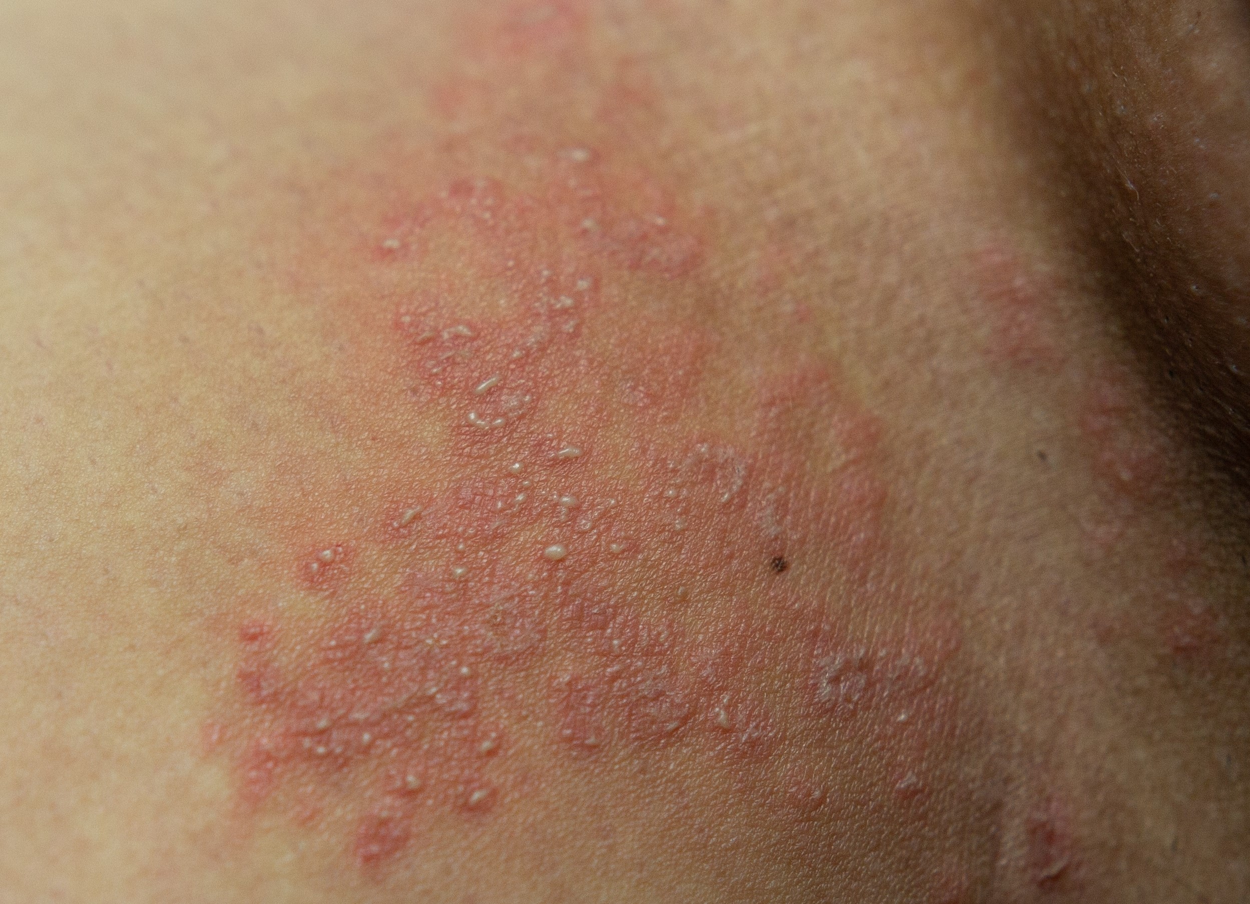 types of mycoses - jock itch