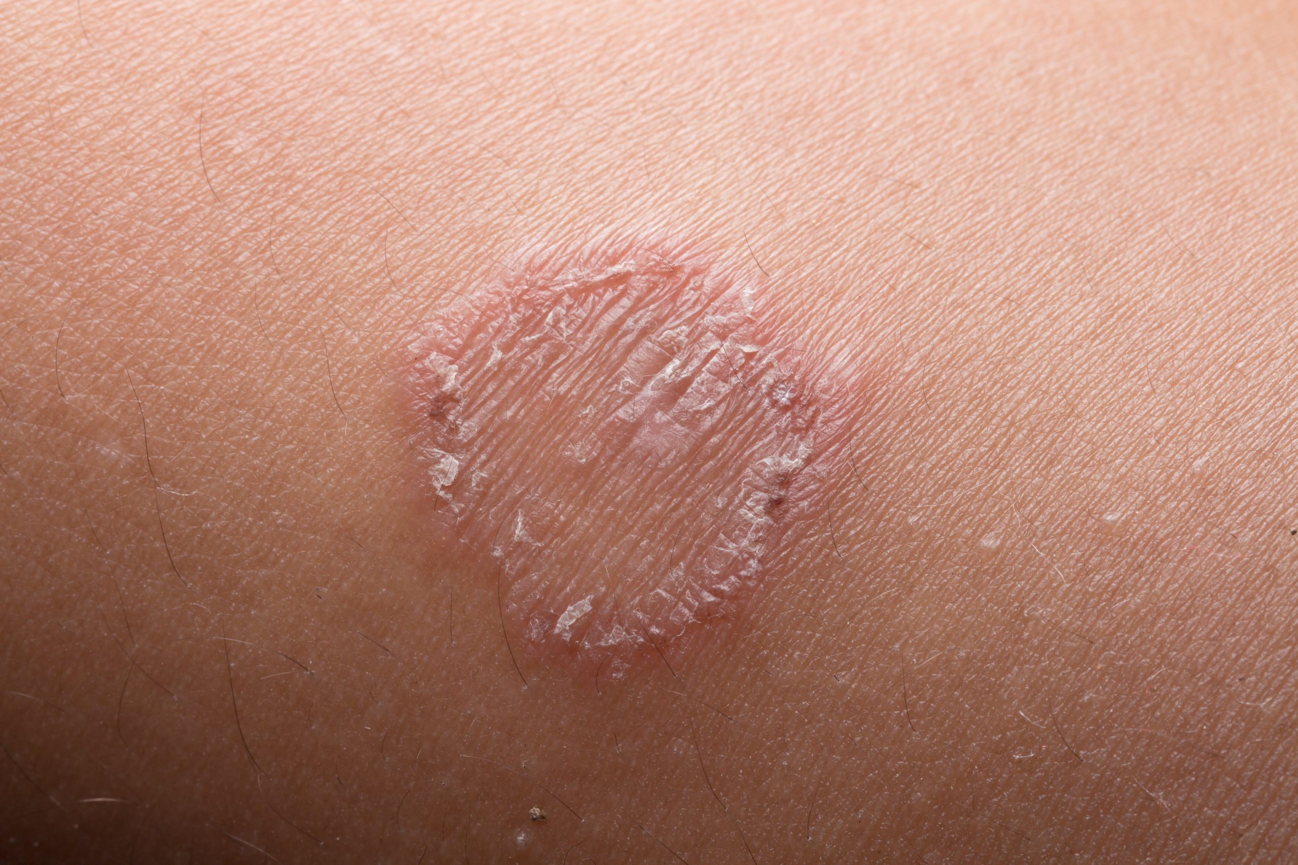 types of fungal skin infections - ringworm